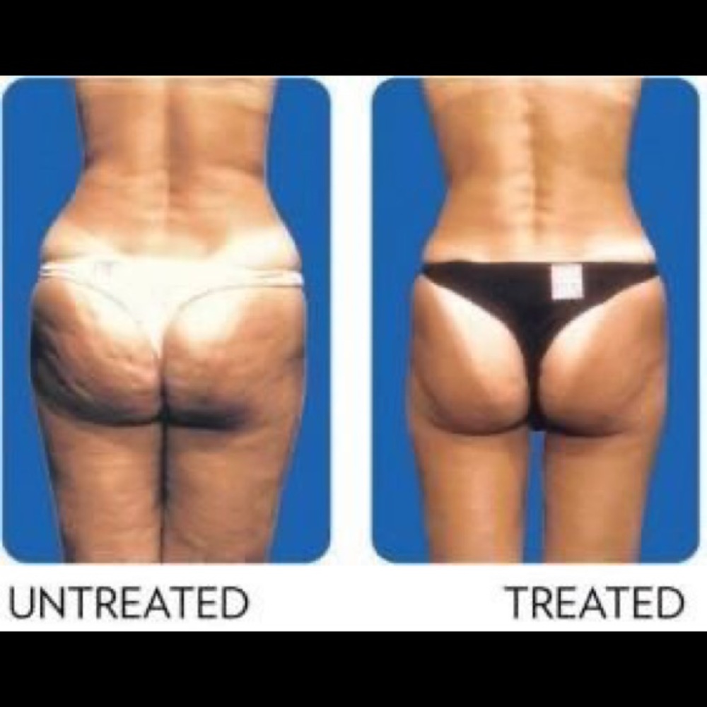 Nu Skin Dermatic Effects cellulite firming cream - Picture 3 of 16